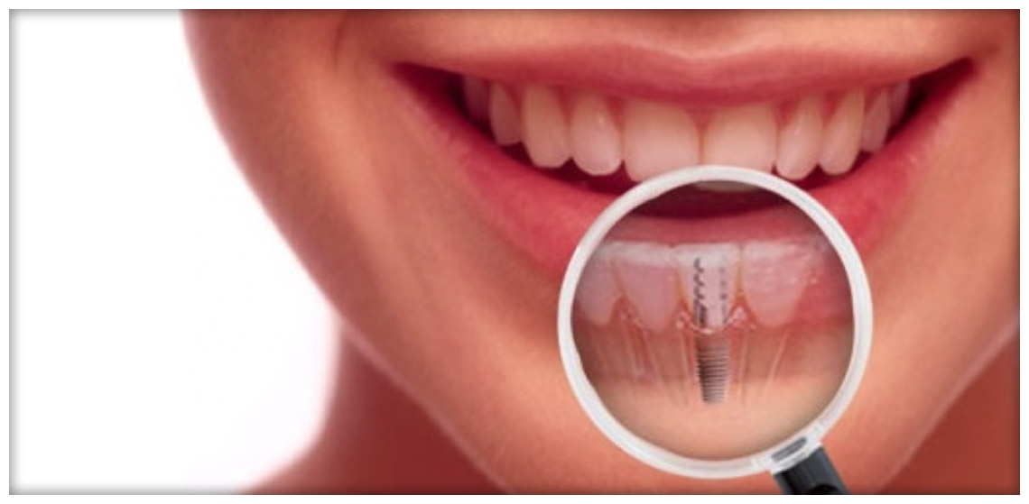 Da odontomil la implantologia Dentale Vaprio d'Adda